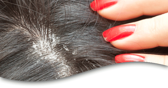 Dandruff - Serious Cases of Dandruff Can Cause Hair Loss