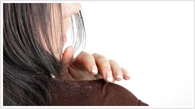 Dandruff_What_Causes_It