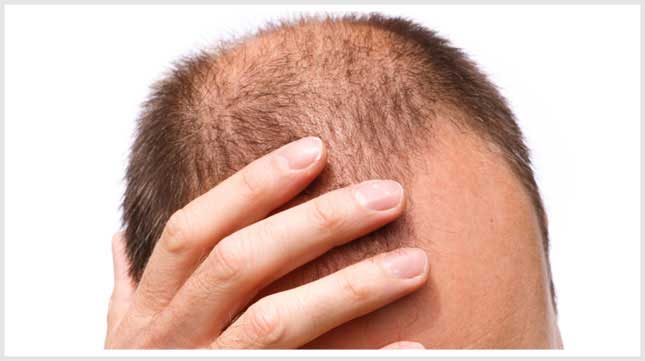 Dispelling-Myths-of-Hair-Loss