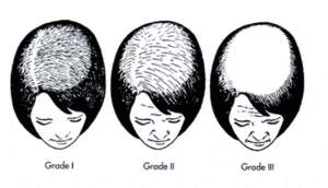 Ludwig Chart 300x172 - Female Pattern Baldness Is a Typically Preventable Disease