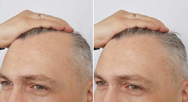 hair loss results for treatments